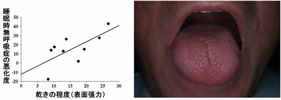 口腔乾燥症