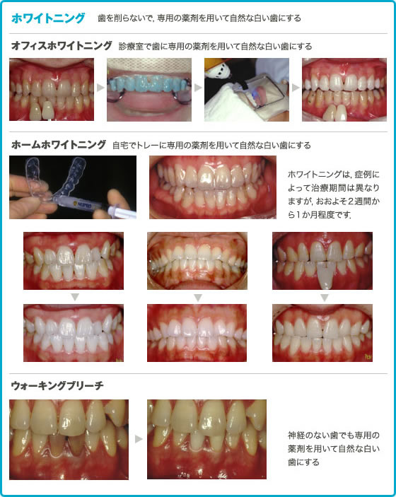 ホームホワイトニング